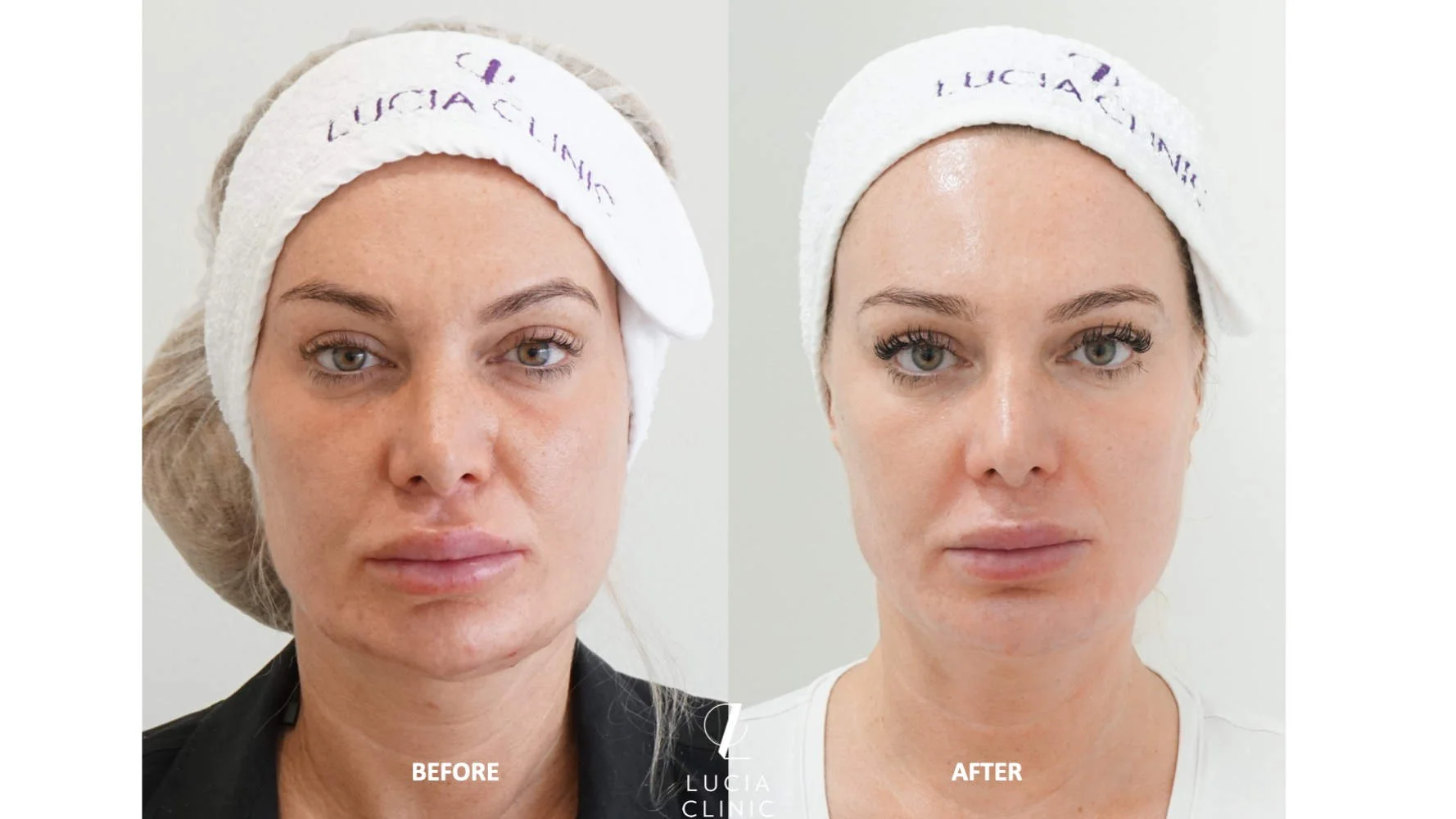 Clear + Brilliant is an effective laser treatment for regular maintenance of skin appearance.