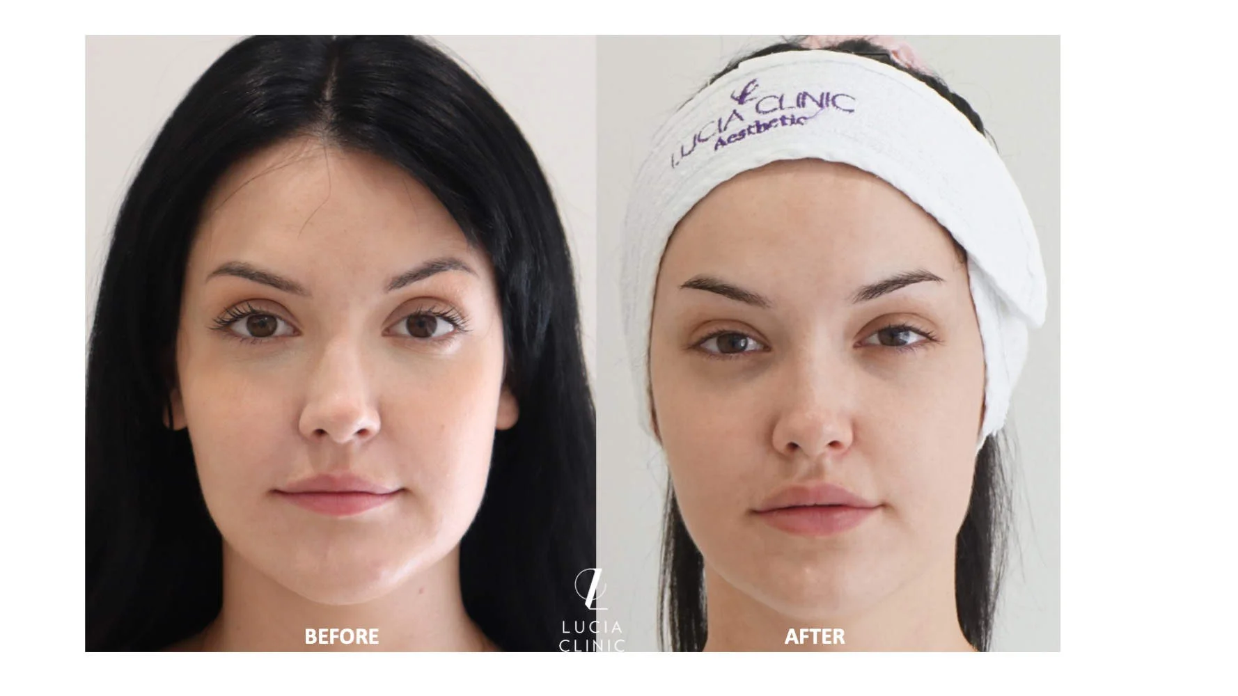 LIP FILLERS - A NATURAL WAY TO PLUMPER LIPS