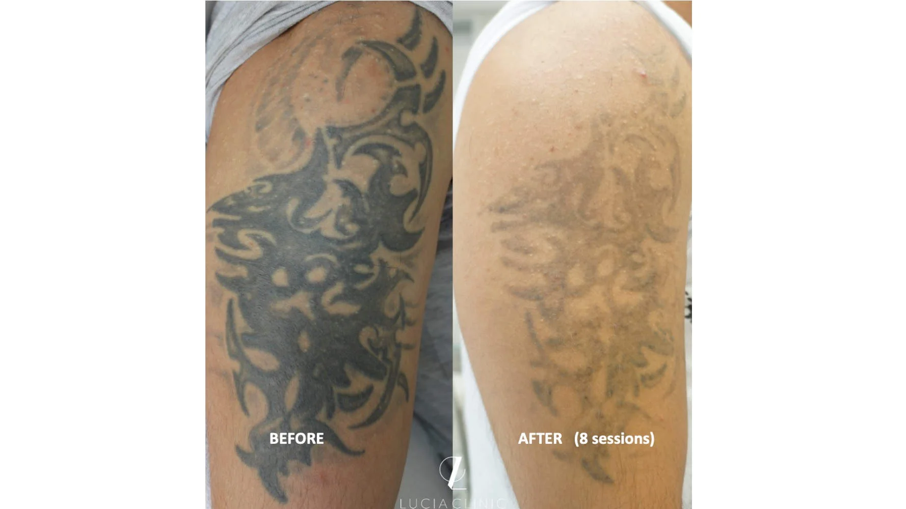 TATTOO REMOVAL PROCEDURE - MAKE THE UNWANTED INK GO AWAY