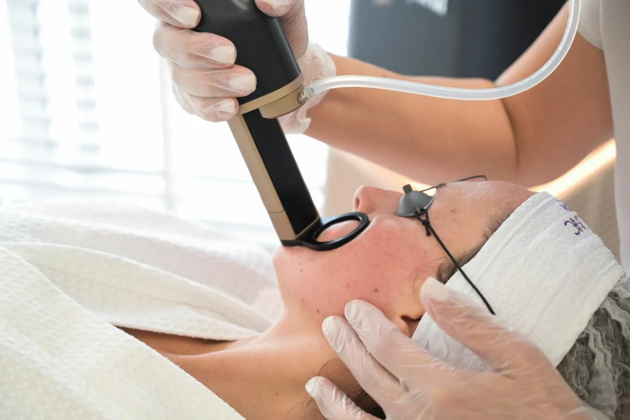 Getting Alma Hybrid Treatment