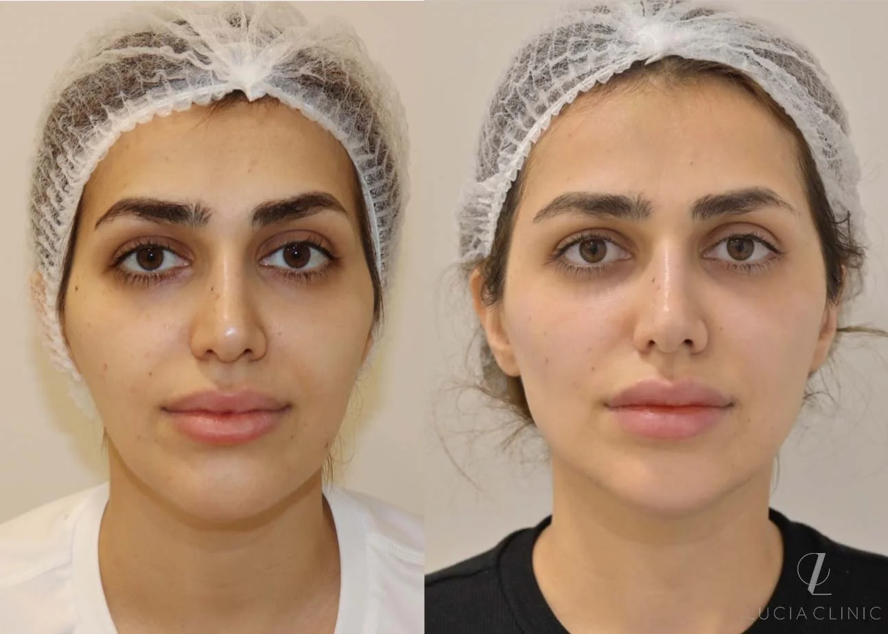 Before and after photo of Dermal Fillers treatment for enhancing the whole face