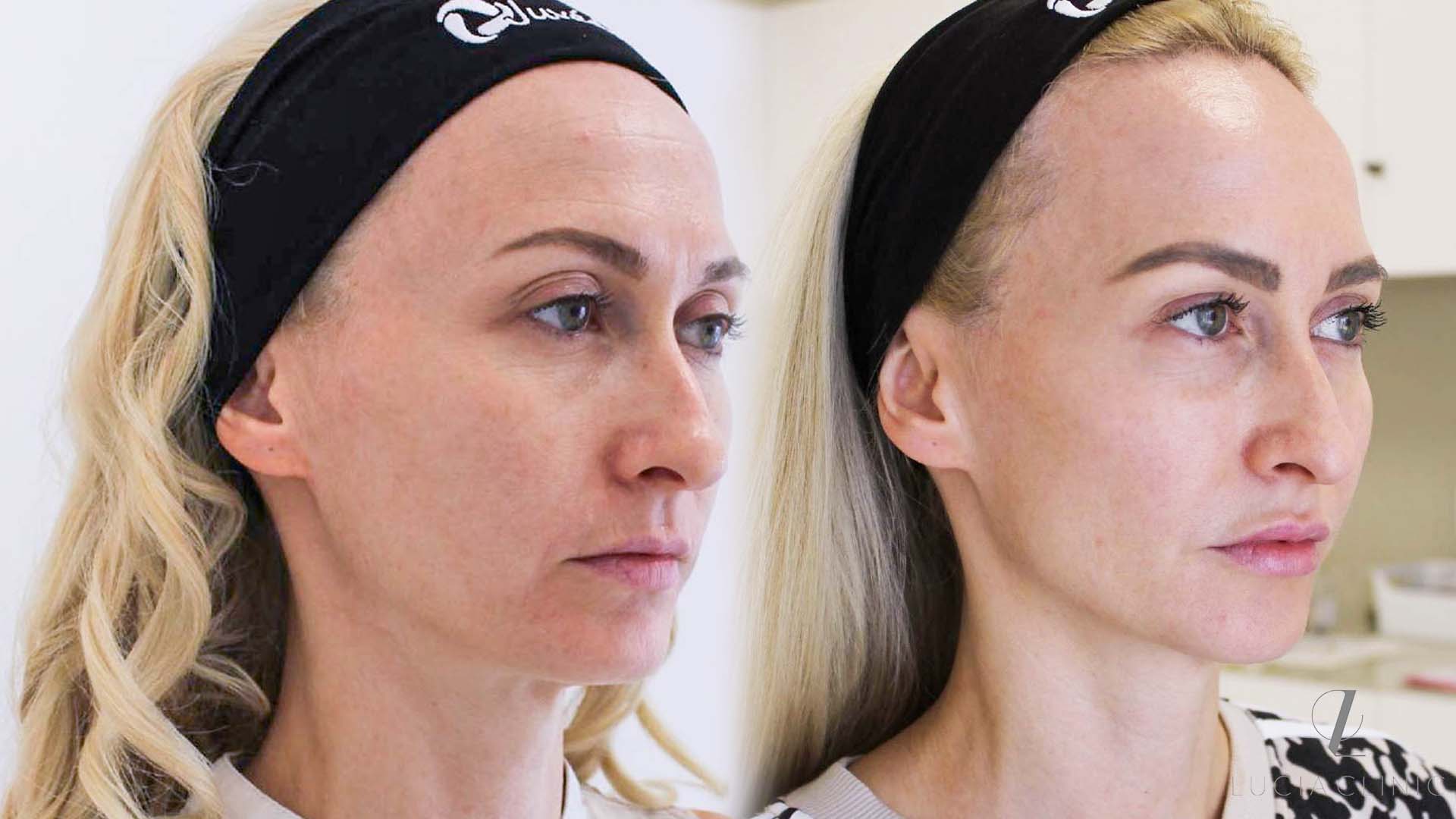 Before and after photo of Dermal Fillers for contouring and defining facial features