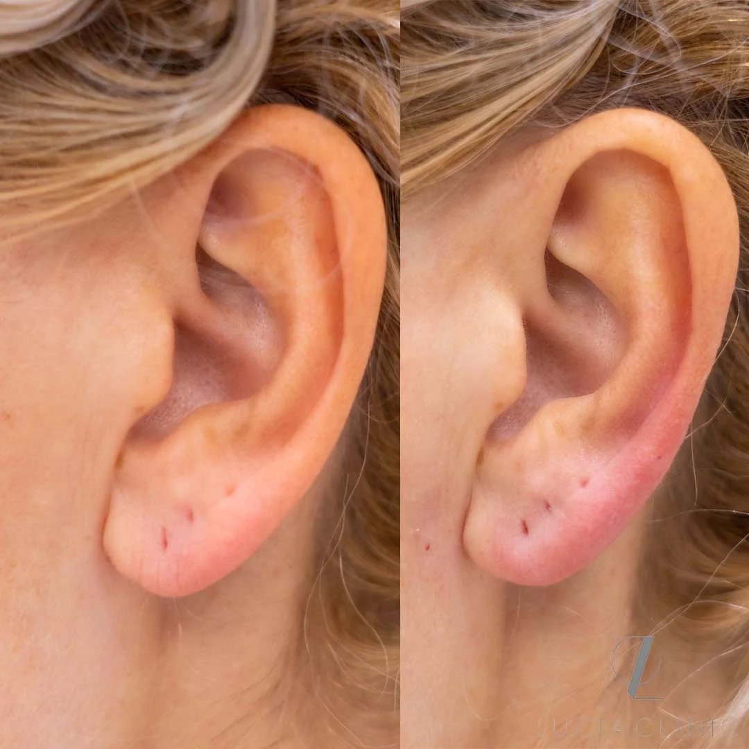 Before and after photo of Dermal Fillers treatment for the earlobes rejuvenation