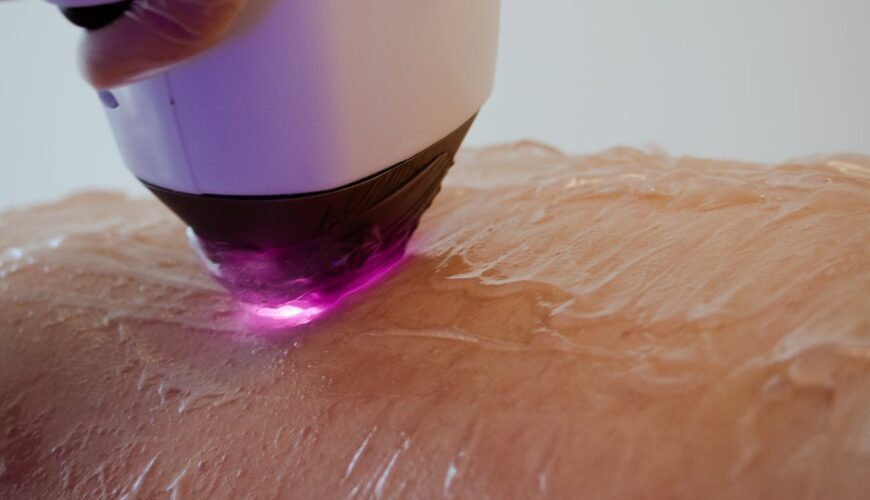 Laser hair removal
