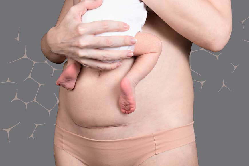 Mummy makeover - plastic surgery to restore pre-baby body