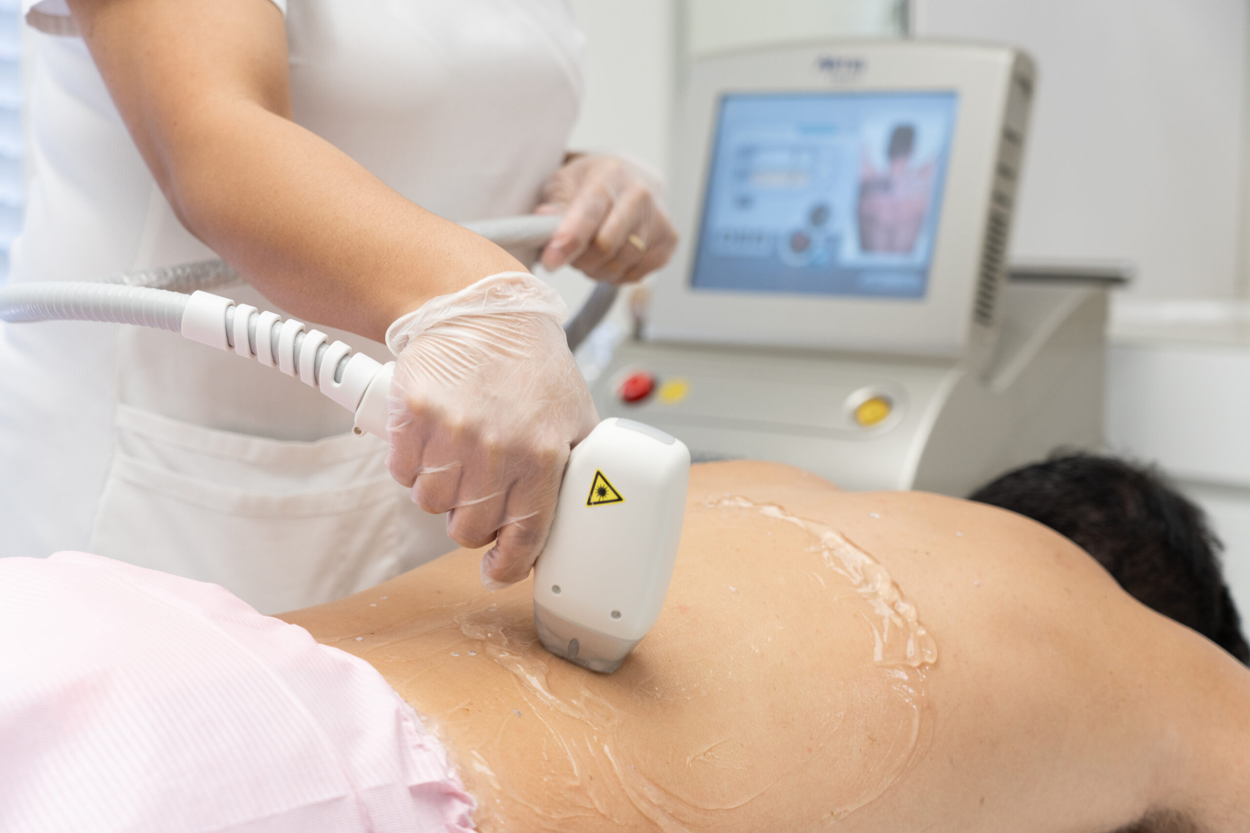 Woman laying on her stomach during the Soprano ice treatment