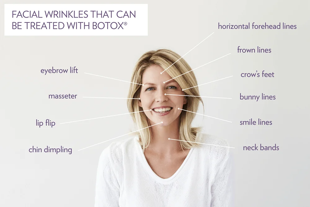 FACIAL WRINKLES THAT CAN BE TREATED WITH BOTOX®