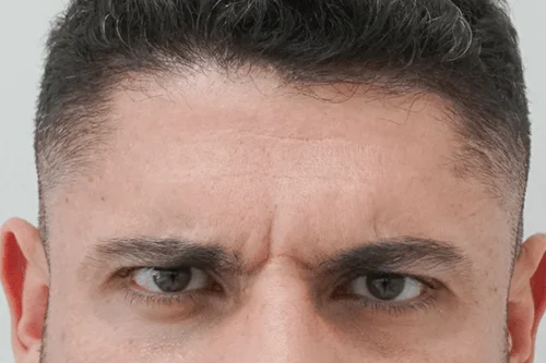 glabellar lines appear between your eyebrows and above your nose