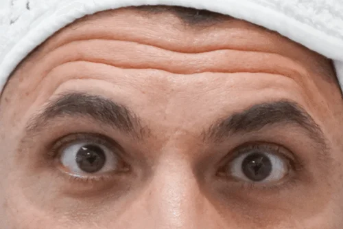 Forehead Wrinkles