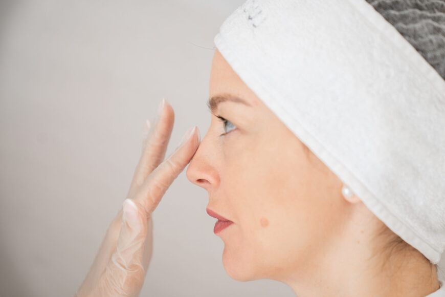 A woman after rhinoplasty