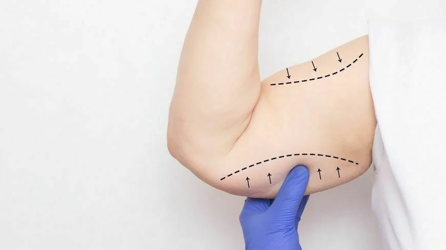 Arm lift plastic surgery for the upper arm rejuvenation – get rid of excess flabby skin from your upper arms and make them better toned and more attractive.