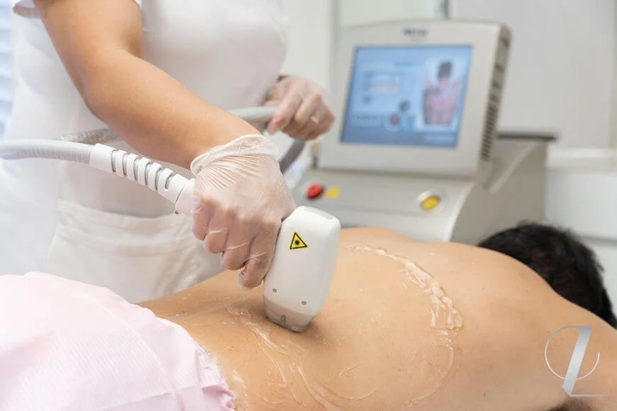 Soprano ICE, the painless laser hair removal treatment