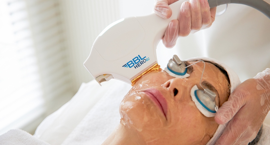 A patient undergoing a BBL Hero aesthetic treatment for skin rejuvenation and glowing skin.