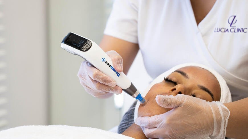 A microneedling device used on facial skin during a PRP session