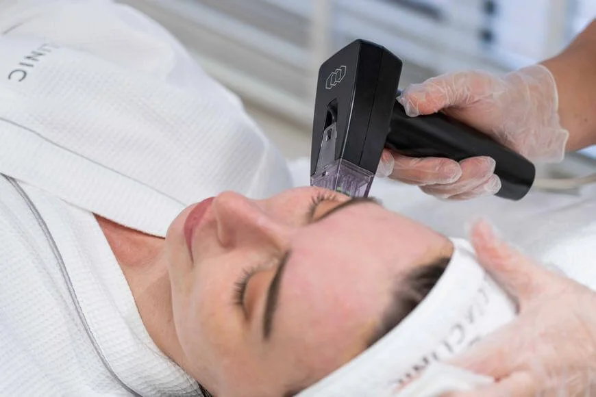 Morpheus8 for fast acne scar elimination at Lucia Clinic
