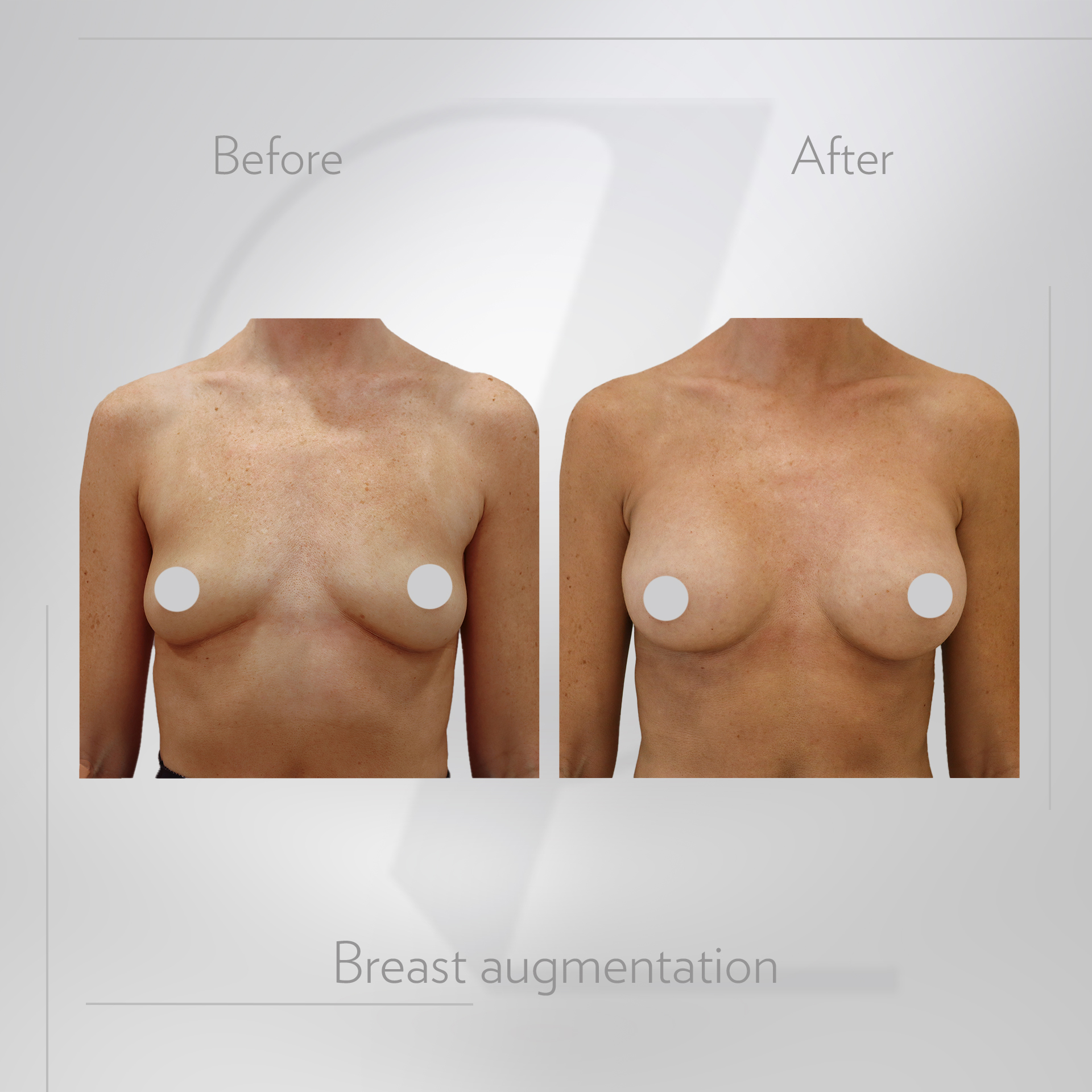 Breast augmentation before and after image