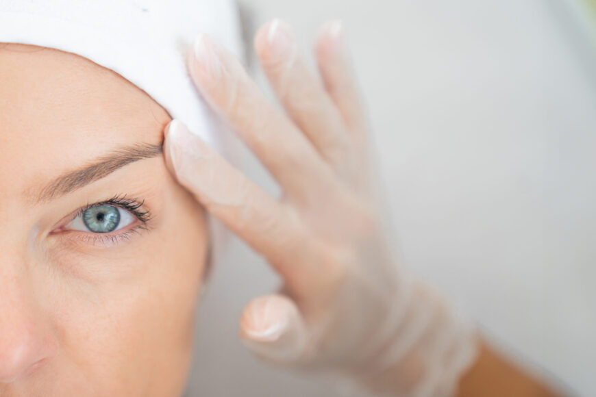 A woman after a brow lift