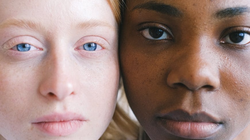 A close-up of two people's eyes, showing the presence of vascular-related dark circles under the eye.