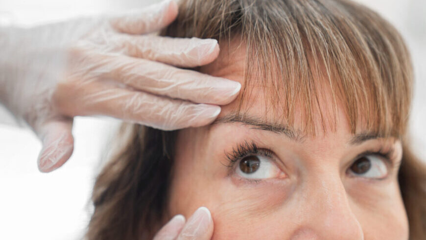 A woman getting ready for blepharoplasty